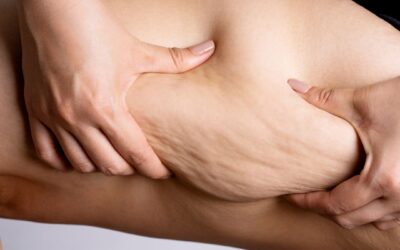 Di adiós a la celulitis: descubre los tratamientos que sí funcionan