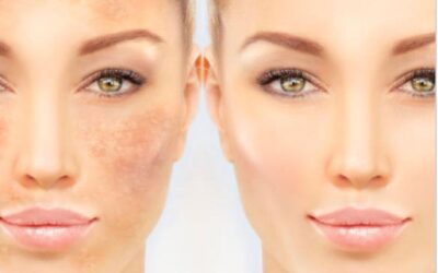 Cómo Eliminar Manchas Faciales en Alcalá de Henares: Tu Guía Experta en Eternity Alcalá